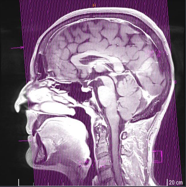 Konfrontation mit dem eigenen Tod MRT meines Schädels
