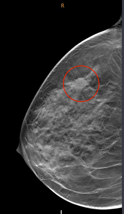 Tomosynthese der Brust mit markiertem Brustkrebs